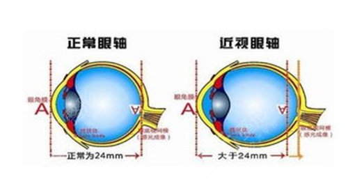 青岛近视眼手术大概多少钱
