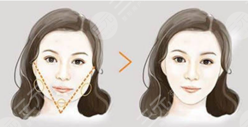 下颌角磨骨术后恢复