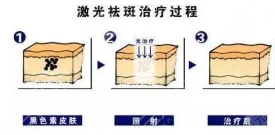 激光祛斑是什么意思呢