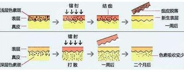 激光祛斑需要花费多少价格呢