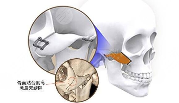 上海九院颧骨内推整形科普