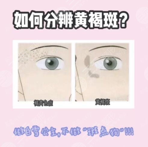 激光祛黄褐斑果能维持多久