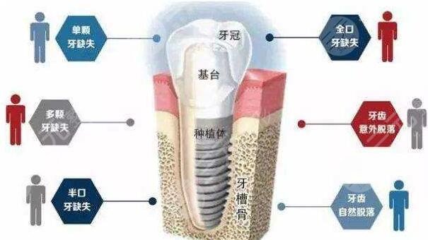 种植牙技术好不好