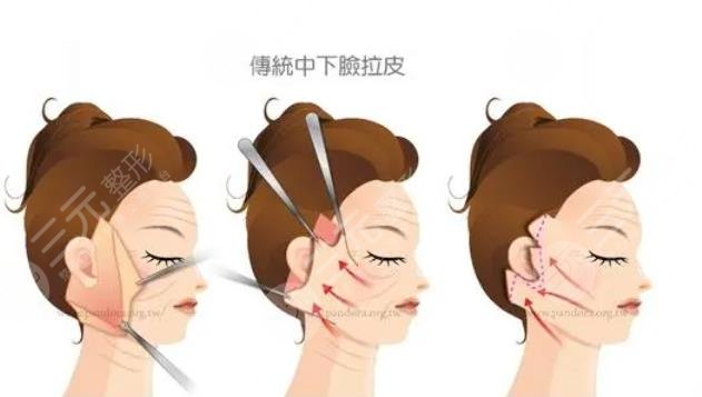 怎样选择除皱的方式