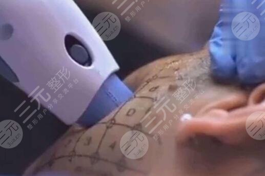 什么是热玛吉？