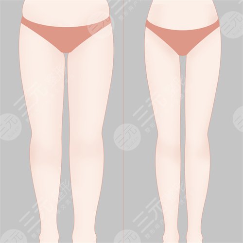 金华芘丽芙美容医院吸脂瘦腿?案例