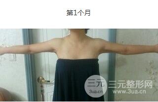 全身吸脂案例