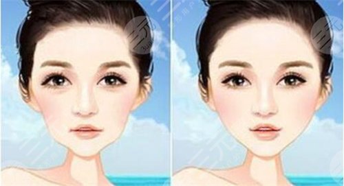 去抬头纹案例