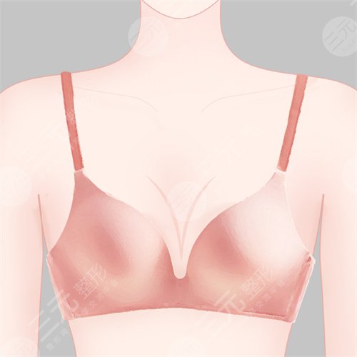 乳房整形案例