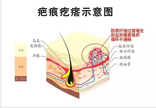 五种除疤方法