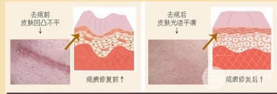 五种除疤方法