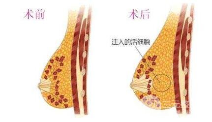 沈阳杏林医院隆胸多少钱呢?