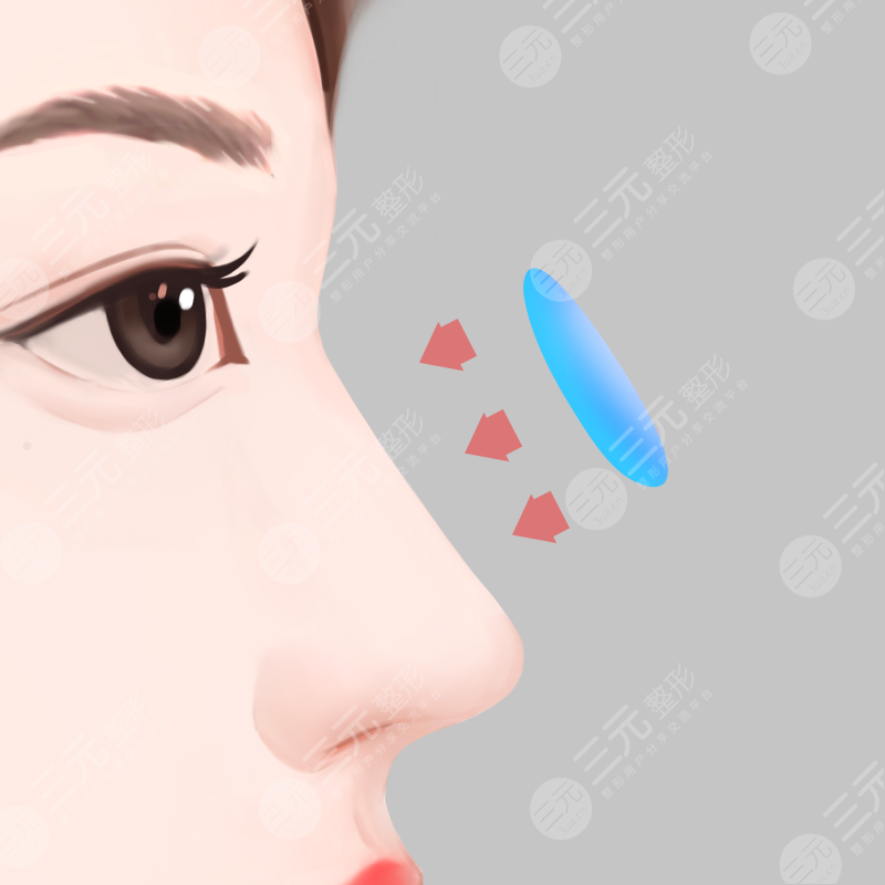 重医附二院整形美容科割双眼皮开眼角怎么样