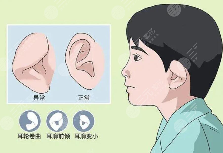杯状耳整形多少钱呢,可以手术吗？手术注意事项有哪些？优质科普回答看这篇就行了~