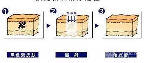 什么是激光美容?