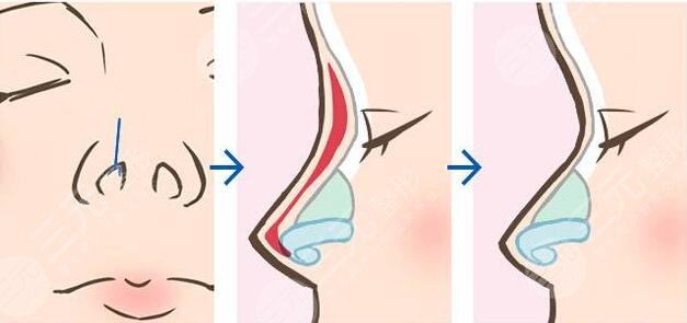 郑大一附院整形科隆鼻案例图
