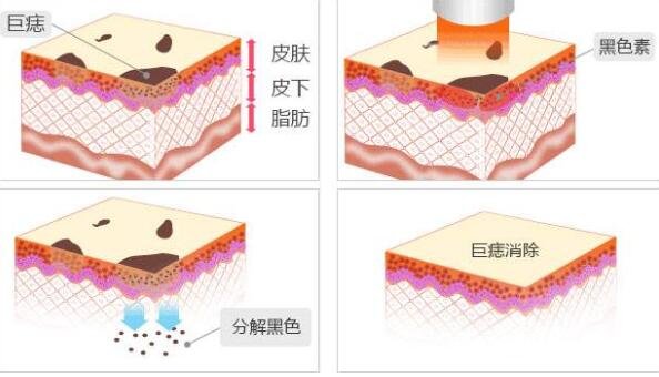 点痣知识