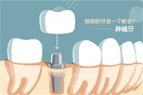 厦门口腔医院种植牙价格表