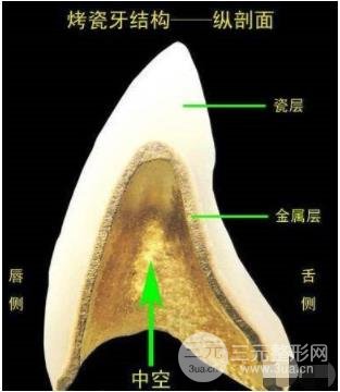 做烤瓷还是种植牙