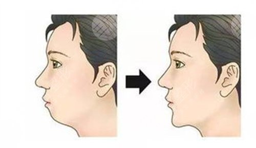 整牙后鼻子变挺