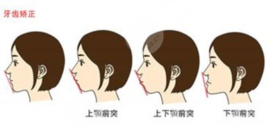 北大口腔医院整牙价格表