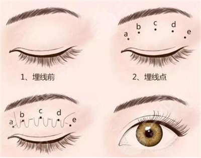 北京画美医院双眼皮案例术前