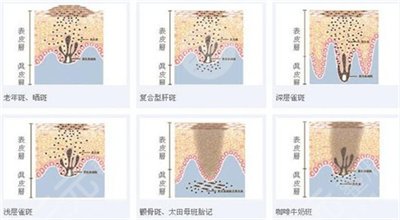 南宁解放军303医院整形美容中心激光祛斑反馈