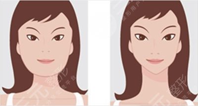 沈阳杏林美容院整形医院磨骨案例