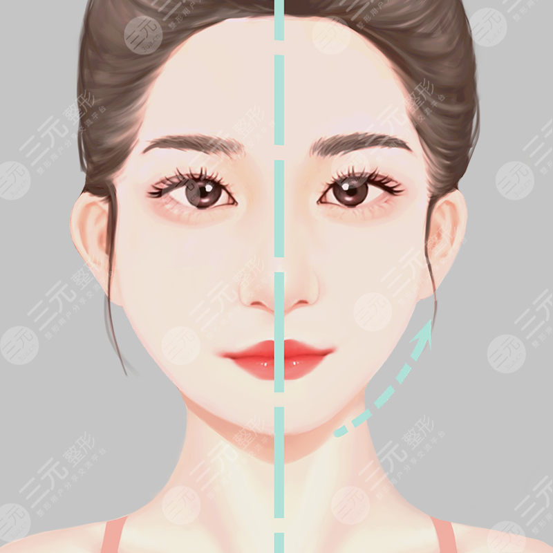 青岛青医附院整形美容双眼皮案例