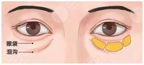 去眼袋术后20天