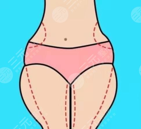 大连大学附属新华医院整形外科抽脂减肥后