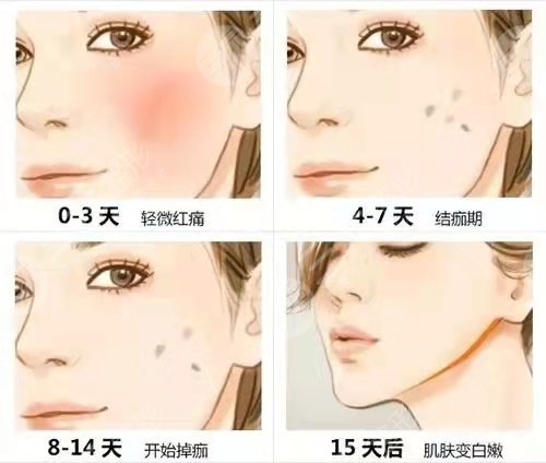 华山医院非剥脱点阵祛痘疤案例前