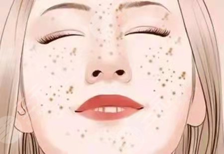 华山医院非剥脱点阵祛痘疤案例后