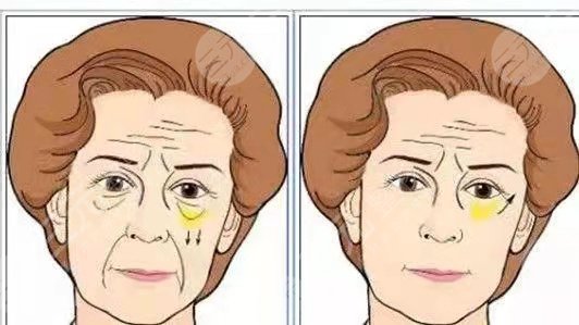 上海九院热玛吉术前