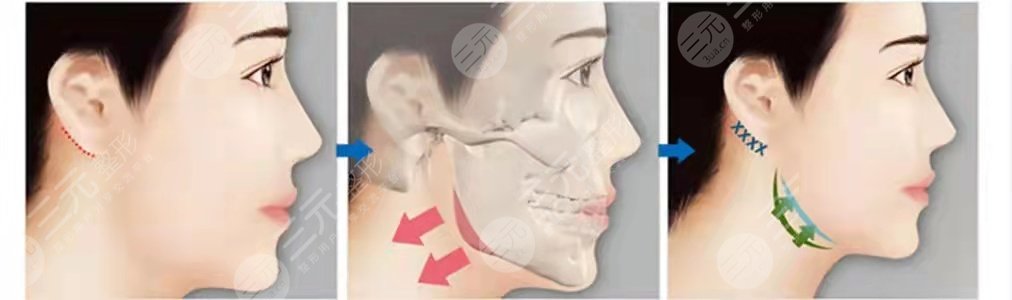 上海九院热玛吉术后