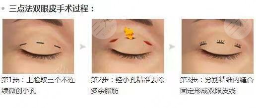 山东省立医院双眼皮案前