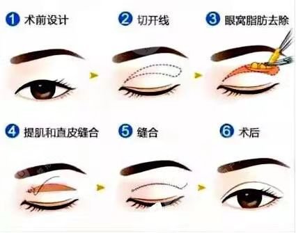 山东省立医院双眼皮案后半个月