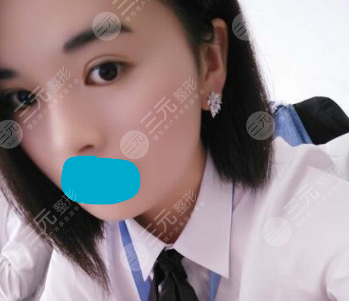 西京医院点阵激光价格