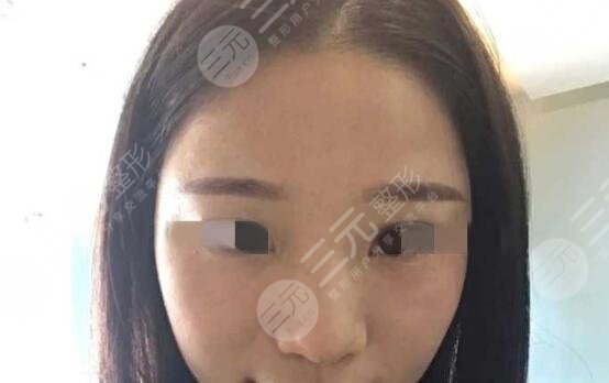 上海李安平隆鼻前