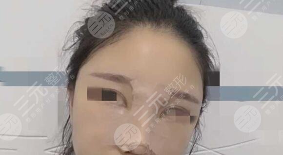 肋骨鼻手术后一周