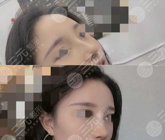 肋骨鼻手术后一个月