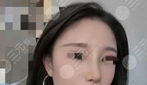 肋骨鼻手术后果