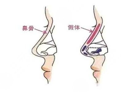 鼻骨矫正的步骤如下