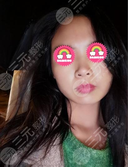 上海新星医疗美容杨杰隆鼻前