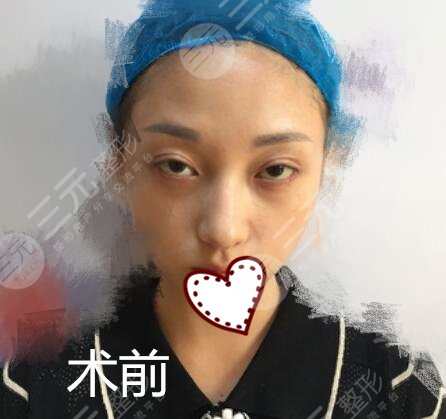 上海九院隆鼻真实果图