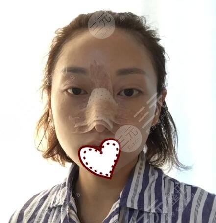 上海九院隆鼻真实果图