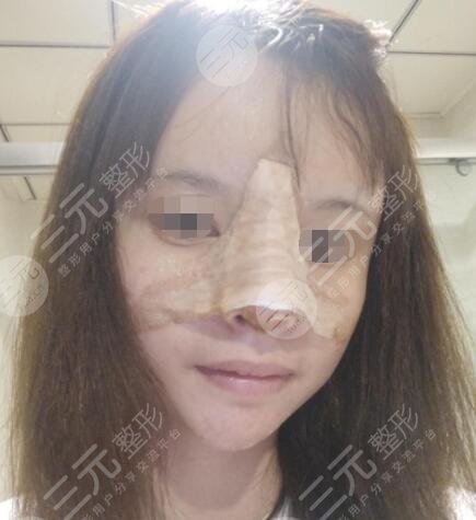 上海九院美容整形科隆鼻当天