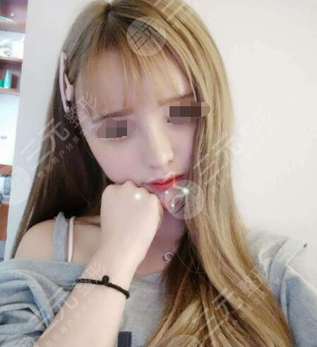 上海九院美容整形科隆鼻术后30天