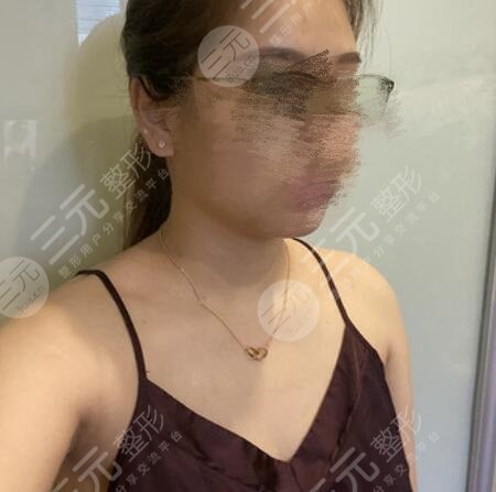 隆胸案例