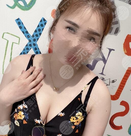 隆胸案例